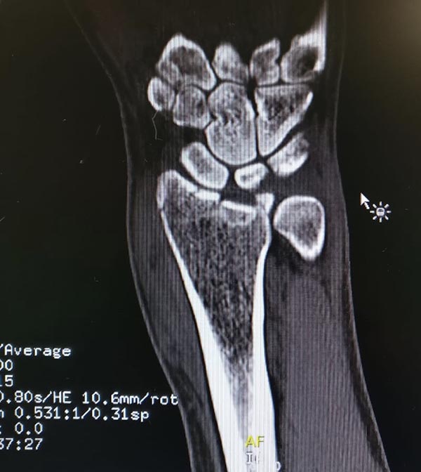 fractura de barton inversa